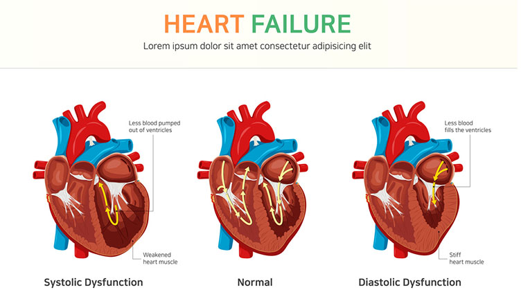 慢性心衰治疗，信立泰JK07或将破局！