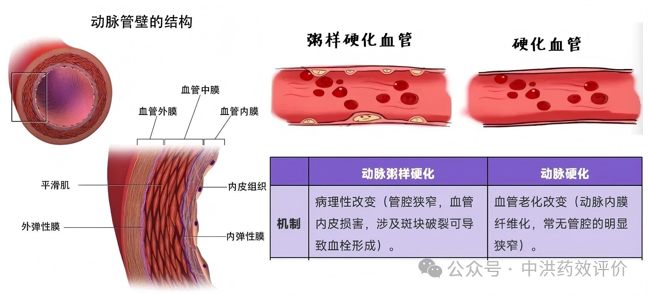 动脉粥样硬化研究2025年终盘点:从全新机制到新药上市,防线再升级