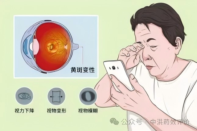 视网膜黄斑变性模型 | 从针头到滴剂:眼科给药的无创革命,改写患者治疗体验