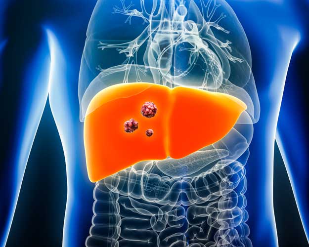 突破耐药困局!肝癌靶向与免疫治疗迎来多维革新