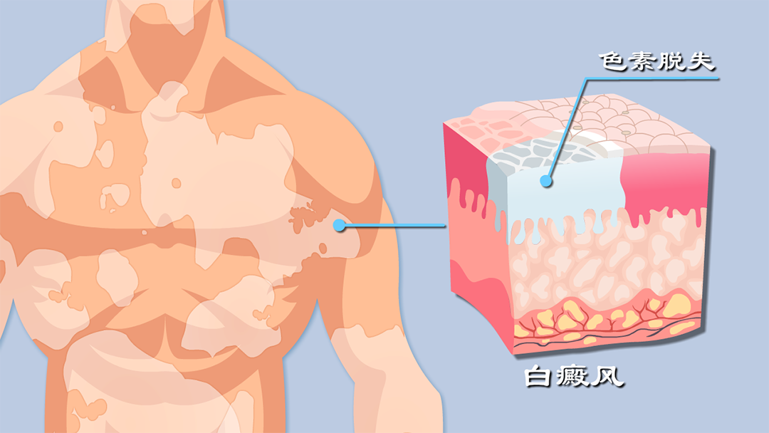 首款且唯一!白癜风重磅创新药国内获批上市 | 附白癜风模型介绍
