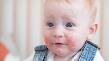 亿人受累!特应性皮炎创新药与靶点研究迎来爆发期