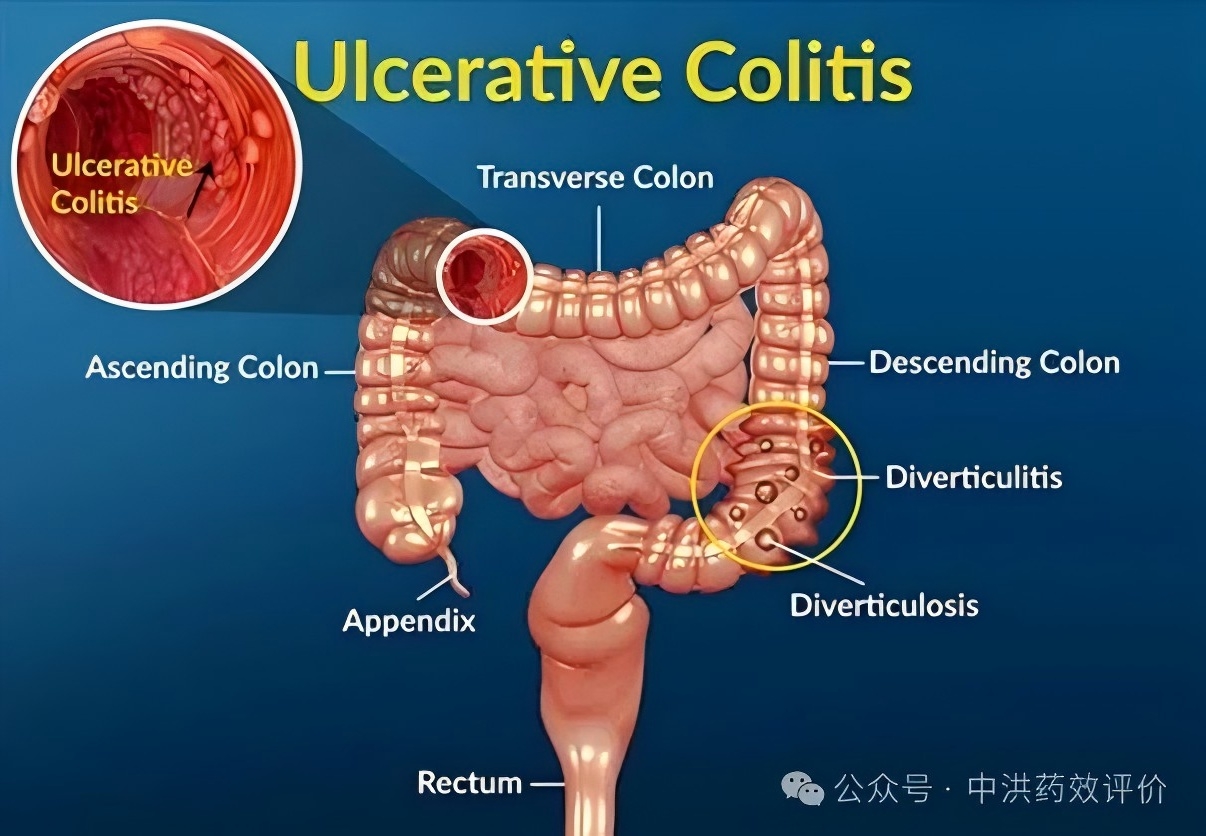病因明确 + 新药获批，溃疡性结肠炎不再 &ldquo;难治&rdquo;